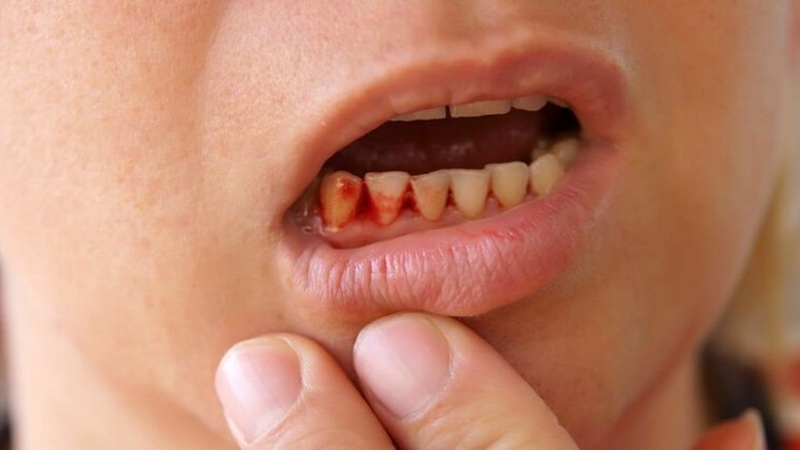 Cắm implant là gì? Có nên thực hiện hay không?  2