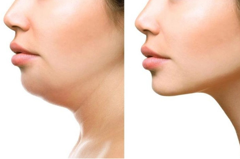 Cằm lẹm: Nguyên nhân, dấu hiệu nhận biết và cách khắc phục 4