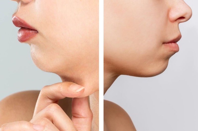 Cằm lẹm: Nguyên nhân, dấu hiệu nhận biết và cách khắc phục 2