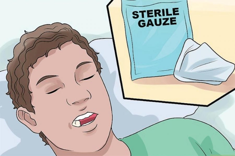 Cần ngậm bông gòn bao lâu sau khi nhổ răng? 1