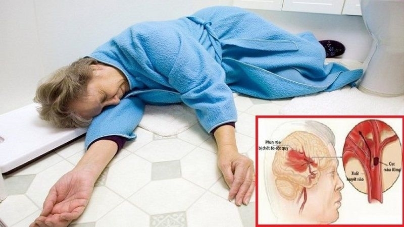 [Cẩm nang] 5 bài thuốc Đông y trị tai biến hiệu quả tại nhà 1