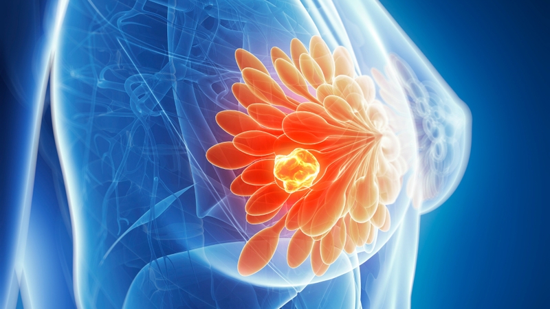 Cẩm nang để sống thọ hơn với ung thư vú là gì? 2