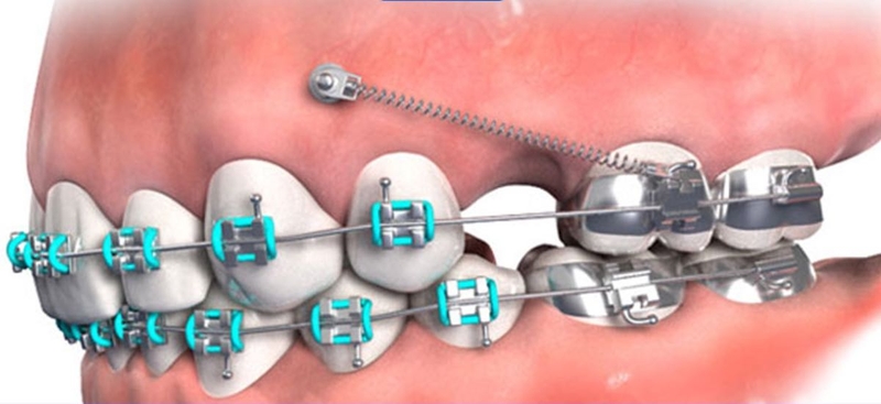 Cắm vis là gì? Khi nào cần phải cắm vis 1