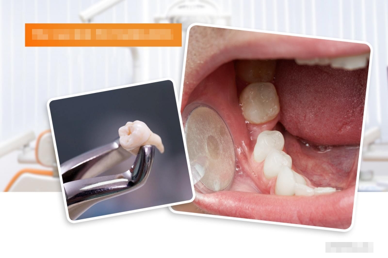 Cắm vis là gì? Khi nào cần phải cắm vis 3