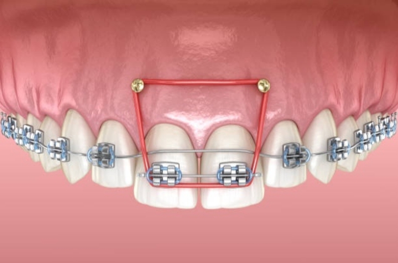 Cắm vít niềng răng bao lâu thì tháo? Niềng răng cần lưu ý những gì? 3