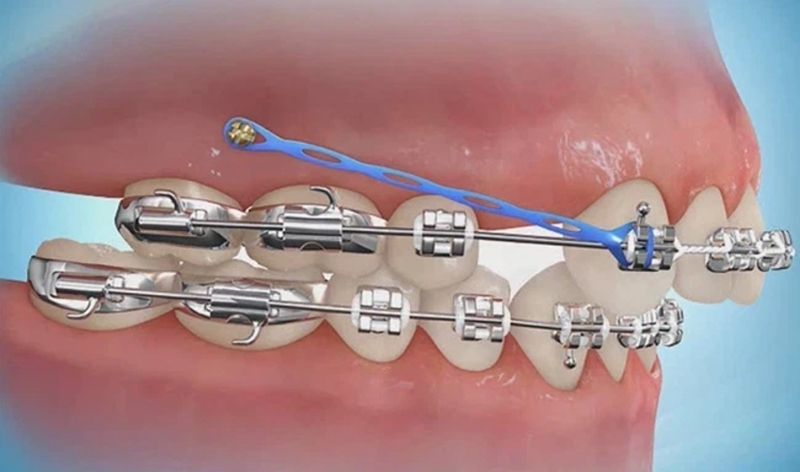 Cắm vít niềng răng bao lâu thì tháo? Niềng răng cần lưu ý những gì? 4