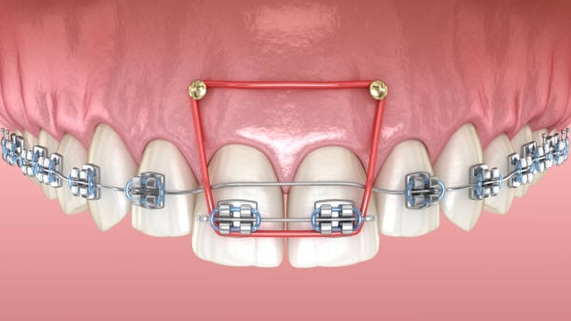 Cắm vít niềng răng có đau không? Những điều bạn cần biết 1