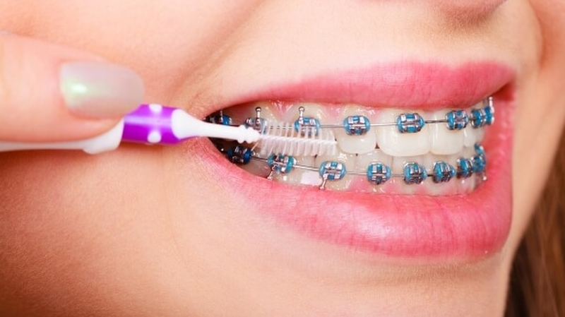 Cắm vít niềng răng có đau không? Những điều bạn cần biết 4