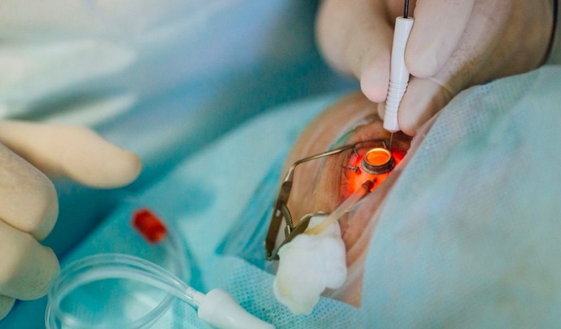 Cần làm gì trước và sau khi mổ Phaco cườm mắt? 1