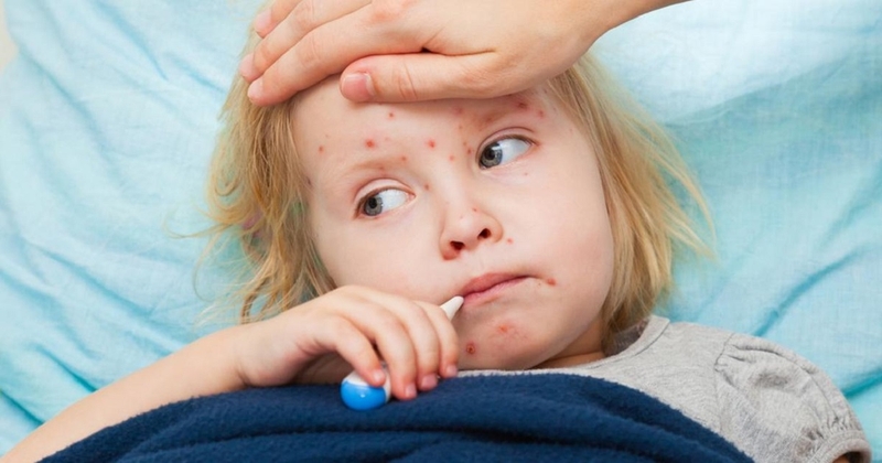 Cần lưu ý khi xử lý bệnh nhân bị thủy đậu 3