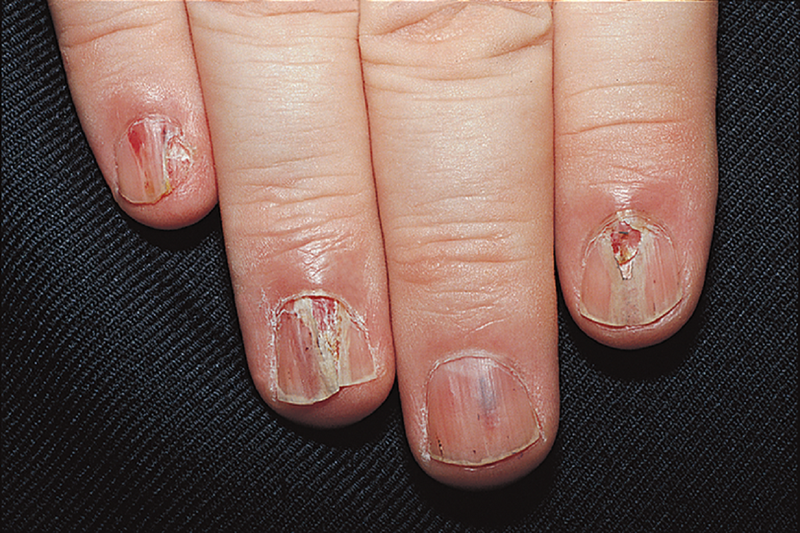 Thường xuyên rửa tay giúp giảm thiểu tác hại của việc cắn móng tay 4