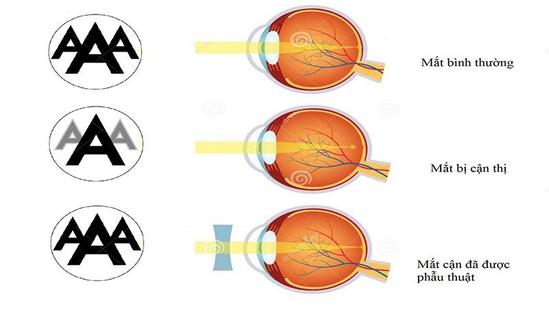 Cận thị có giảm độ được không? Các phương pháp điều trị cận thị hiệu quả 3