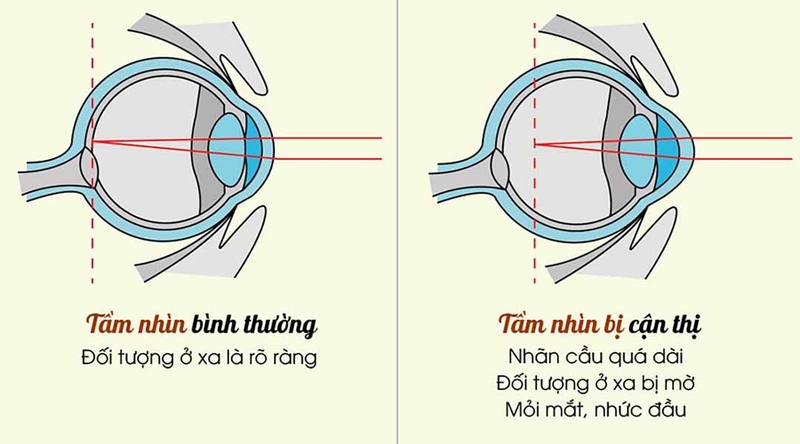 Cận thị giả là gì? Cách nhận biết như thế nào? 1