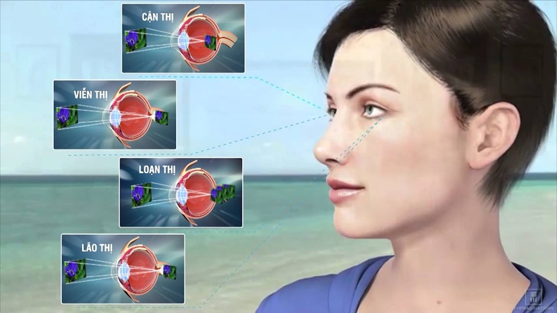 Tìm hiểu về các loại cận thị có thể mắc phải 1