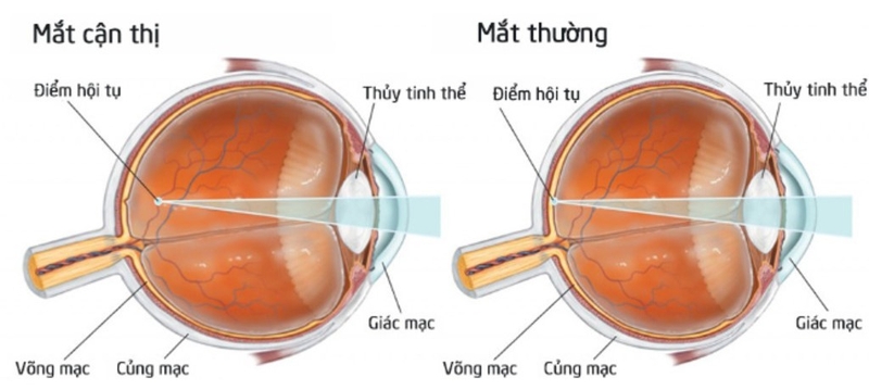 Cận thị sau 30 tuổi có nguy hiểm không? 2