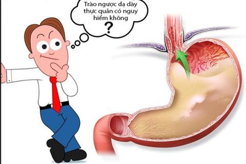 Cẩn trọng nguy cơ trào ngược dạ dày gây ung thư 1