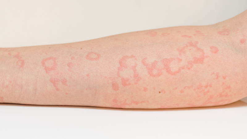 Cẩn trọng với các bệnh da liễu thường gặp khi thời tiết nồm ẩm 3