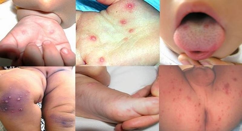 Cẩn trọng với những dấu hiệu của bệnh tay chân miệng