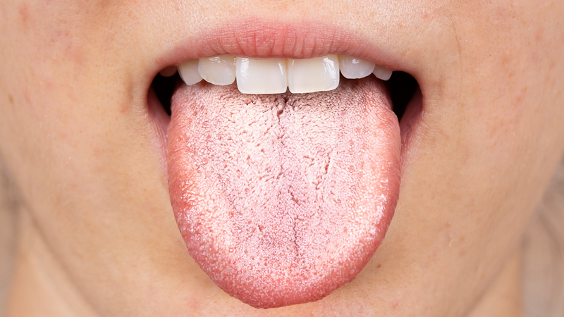 Nhiễm Candida ở miệng có thể gây mảng trắng trên lưỡi