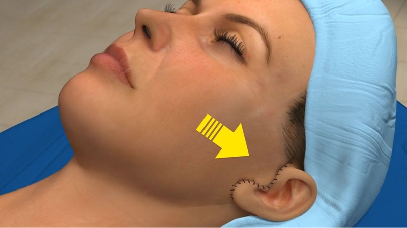 Căng da mặt SMS tác động vào lớp mô liên kết nằm dưới da nên hiệu quả rõ rệt