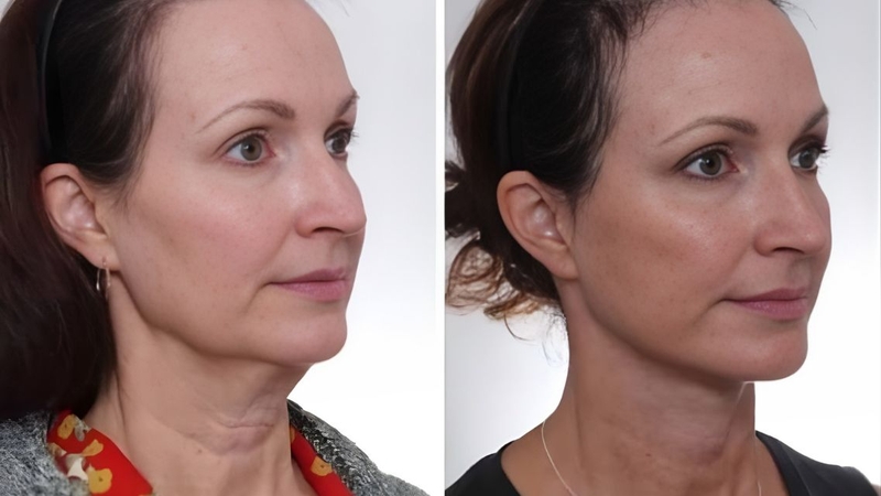 Đây là phương pháp căng da mặt có nhiều ưu điểm, hiệu quả lâu dài