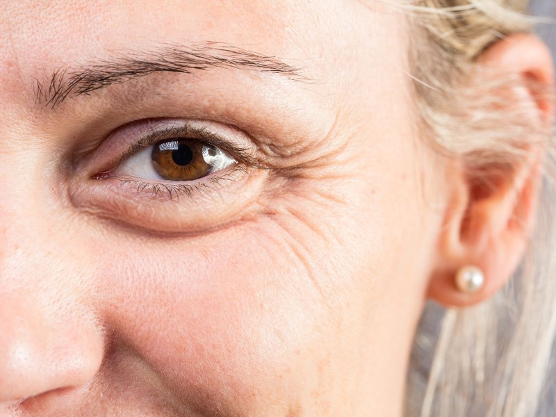 Căng da mặt mini: Phương pháp làm đẹp an toàn và hiệu quả hiện nay 2