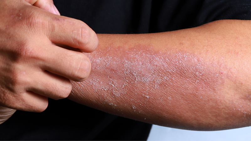 Tiếp xúc với nước bẩn làm tăng nguy cơ mắc các bệnh ngoài da