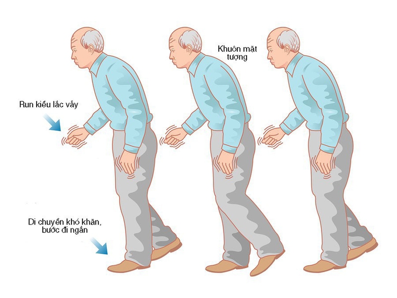 Cảnh báo 5 dấu hiệu bệnh Parkinson thường gặp 3