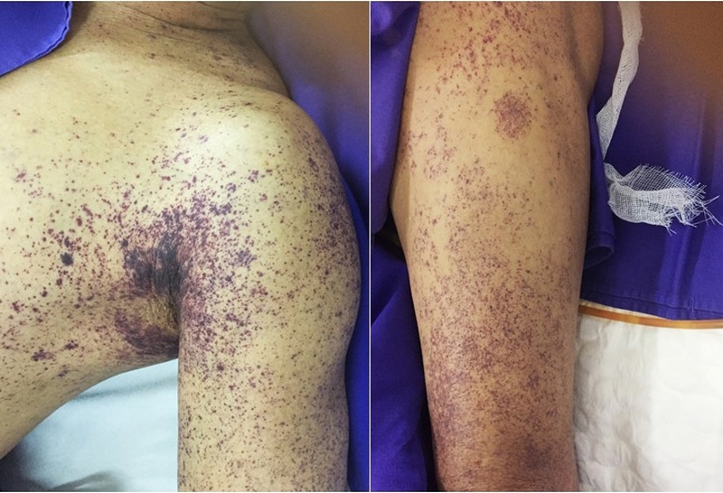 Cảnh báo các triệu chứng sau khi ăn tiết canh vịt - Đọc ngay! 5