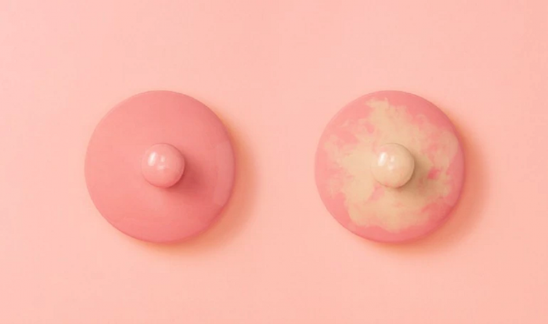 Có máu trong sữa mẹ là do núm vú bị nứt, bị tổn thương