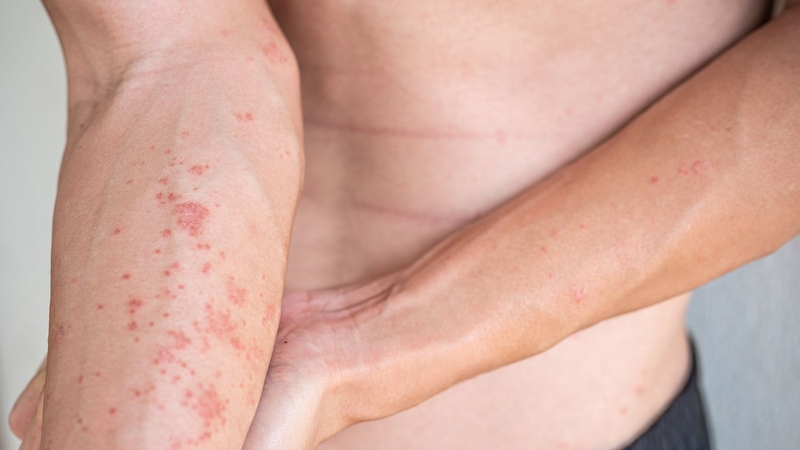 Người bị dị ứng thời tiết thường nổi nốt mẩn đỏ trên da