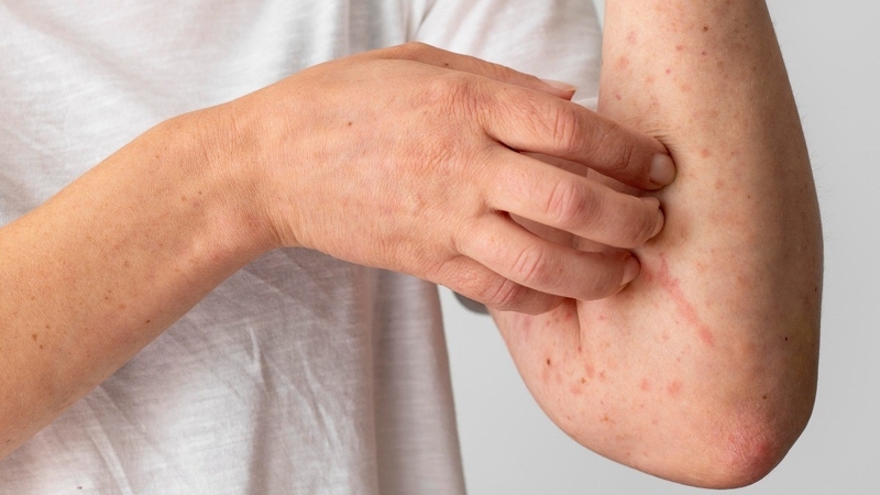 Viêm da dị ứng thời tiết thường gặp vào mùa lạnh