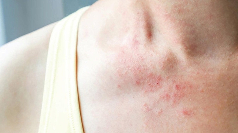 Người có cơ địa nhạy cảm dễ bị dị ứng thời tiết