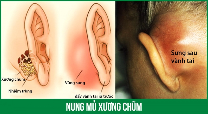 Cảnh giác những biến chứng khôn lường của viêm tai xương chũm có cholesteatoma 1