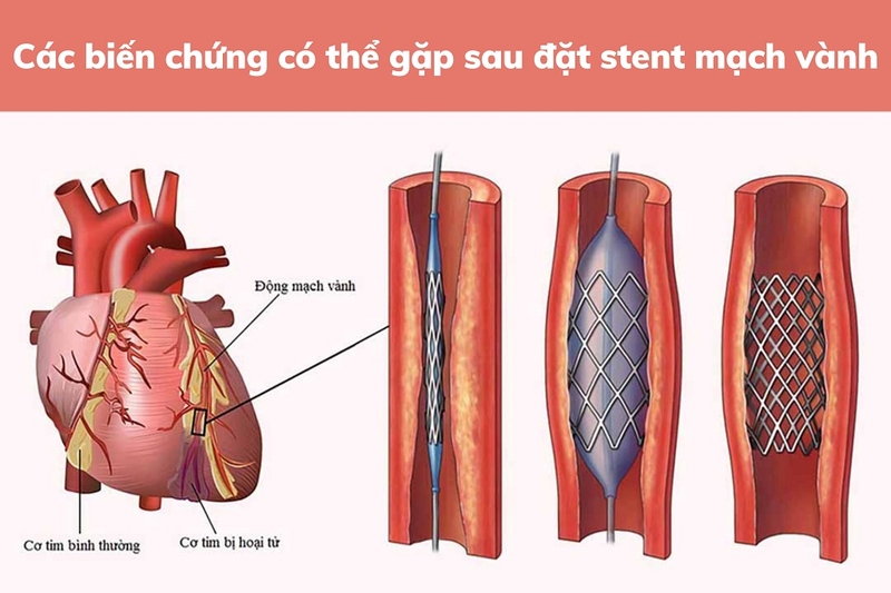 Cảnh giác những biến chứng sau đặt stent mạch vành bạn không được chủ quan 2