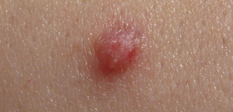 Cảnh giác: Sùi mào gà lây qua đường nào? 1