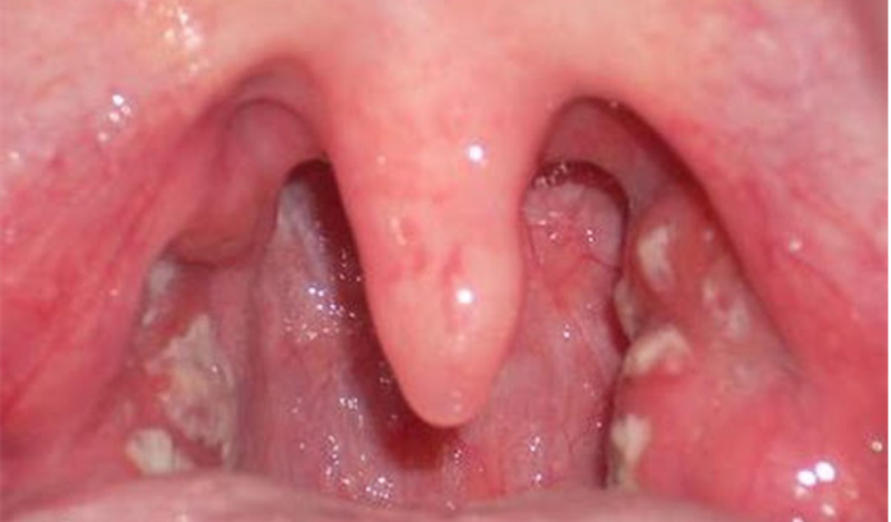 Bệnh nấm họng thanh quản là gì