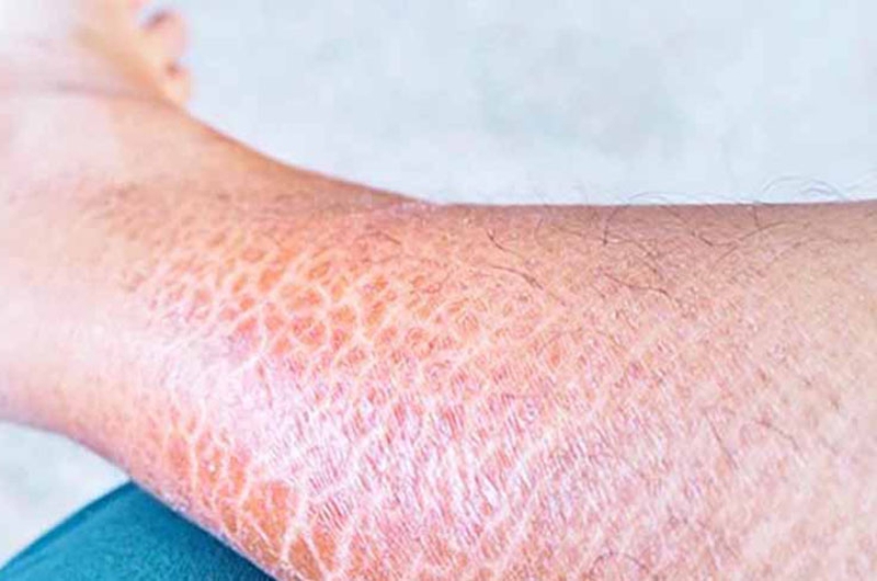 Góc hỏi đáp: Tại sao cạo lông chân lại bị ngứa? 2