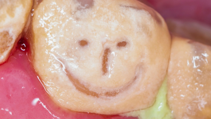 Cao răng độ 4 là gì và cách xử lý bạn cần biết 1