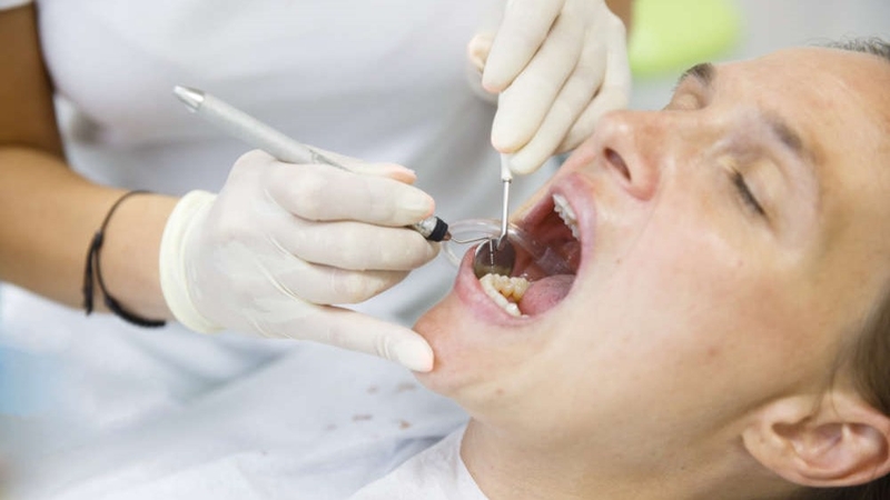 Cao răng là gì? Có tự lấy cao răng được không? 3