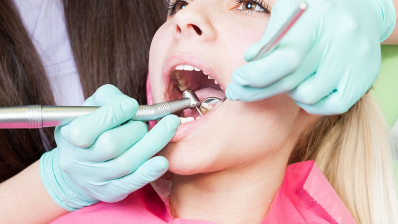 Cao vôi răng độ 1 là gì? Cách nhận biết và quy trình lấy vôi răng độ 1 2