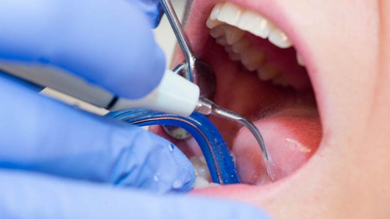 Cao vôi răng độ 1 là gì? Cách nhận biết và quy trình lấy vôi răng độ 1 4