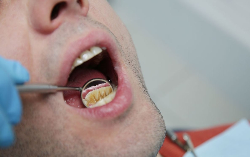 Cạo vôi răng là gì? Lợi ích của việc cạo vôi răng 3