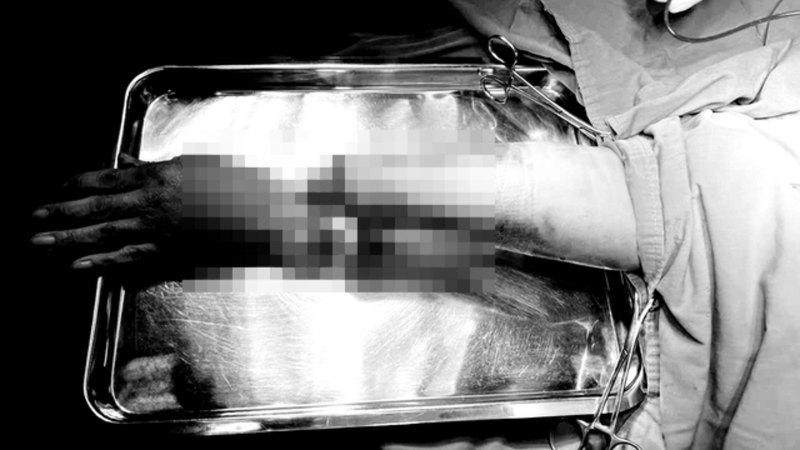 Bàn tay công nhân bị máy cuốn đứt lìa trong ca làm việc ban đêm