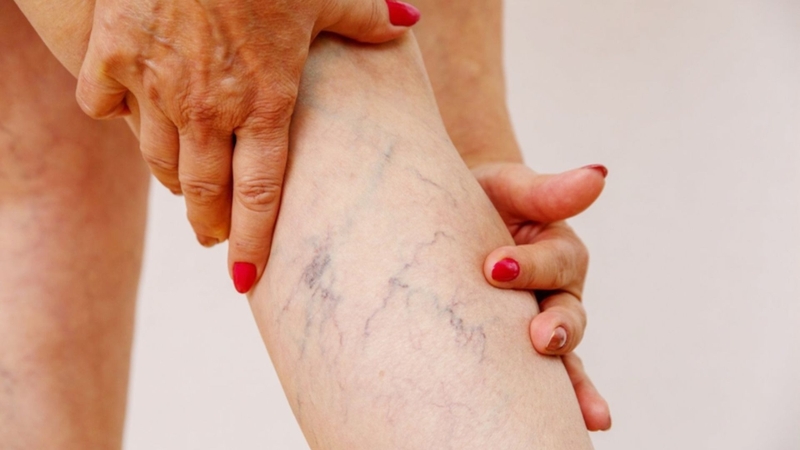 Các tĩnh mạch nông nổi trên bề mặt da là dấu hiệu suy giãn tĩnh mạch cấp độ C2