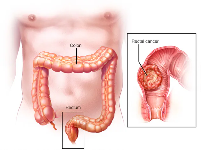 Carcinoma tuyến biệt hoá vừa trực tràng: Cơ chế bệnh sinh, yếu tố nguy cơ, tiên lượng và các phương pháp điều trị 1