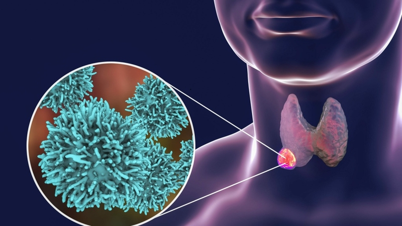 Carcinoma tuyến giáp thể nhú: Hiểu rõ về bệnh lý và cách điều trị hiệu quả 1
