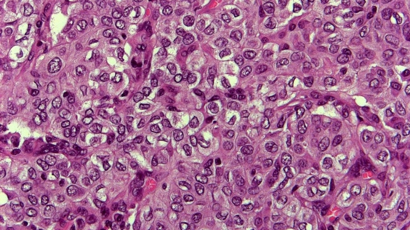 Carcinoma tuyến giáp thể nhú: Hiểu rõ về bệnh lý và cách điều trị hiệu quả 2