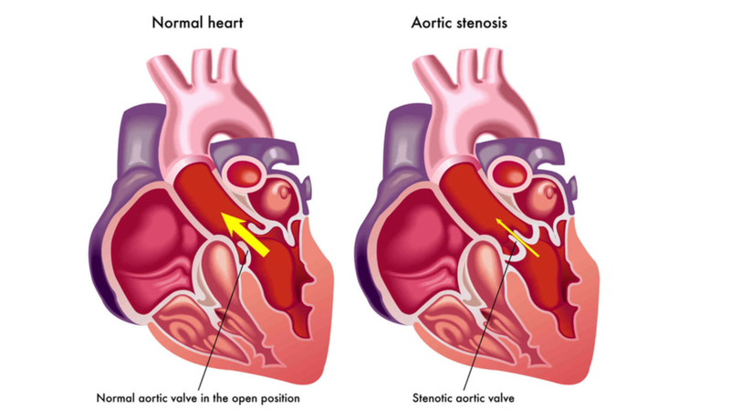 Cardiovascular disease là gì? 4