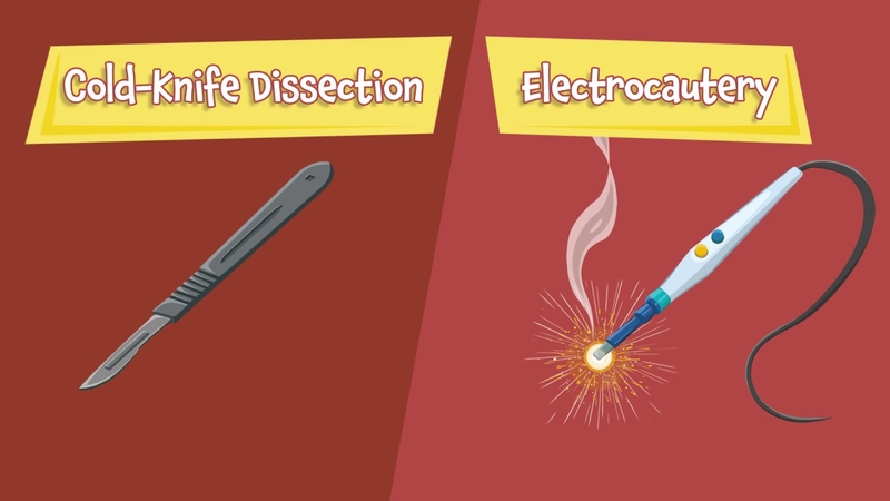 Cắt amidan bao lâu thì hết đau? Chăm sóc sau phẫu thuật như thế nào? 2